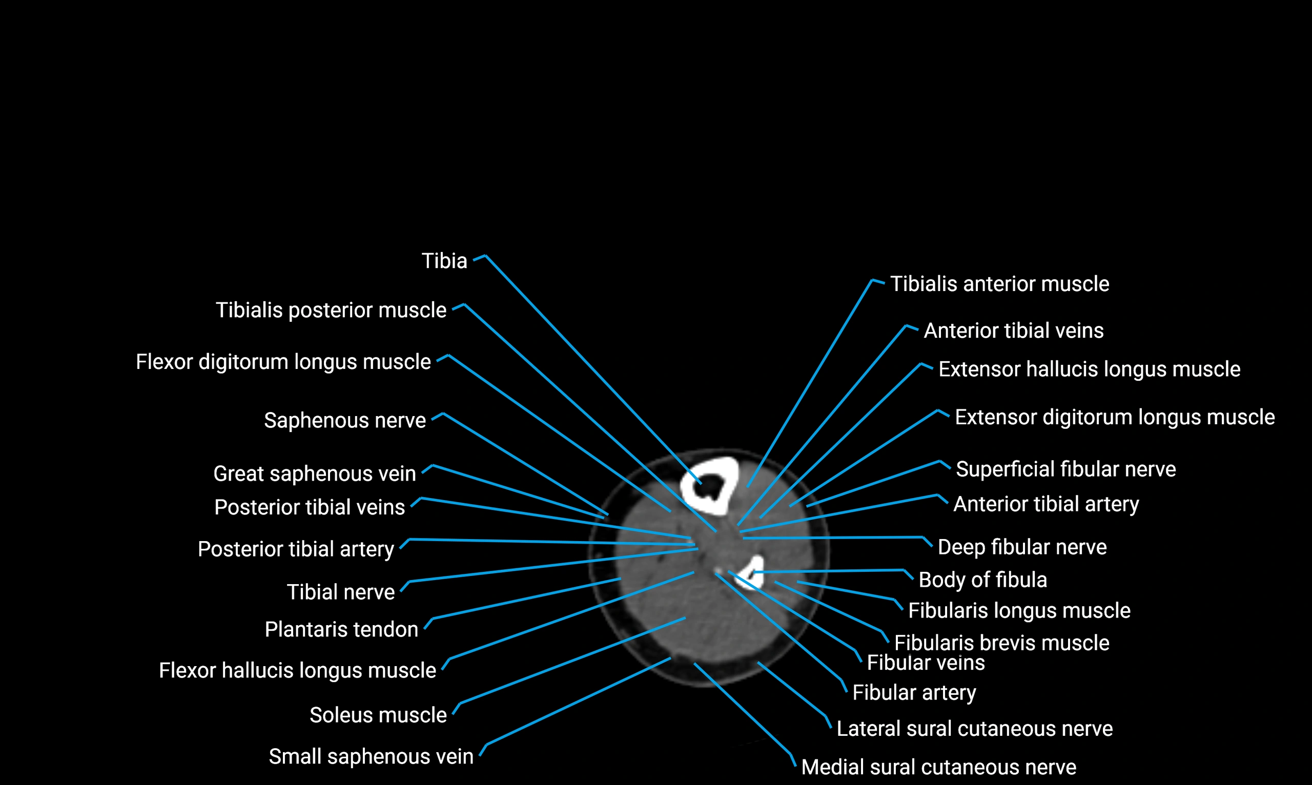 CT lower limb axial cross sectional anatomy labelled image 125 (2).webp